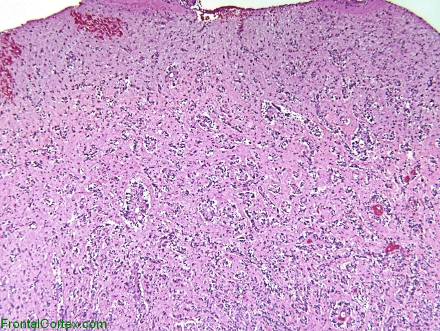 Angiocentric glioma, H&E stain x 20